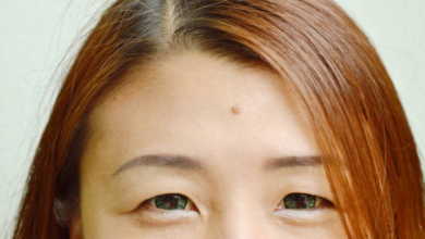 1 asian warts 1